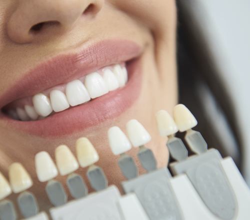 Closeup of smile compared with porcelain veneer shades during cosmetic dentistry visit