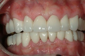 White healthy smile after dental crown restoration