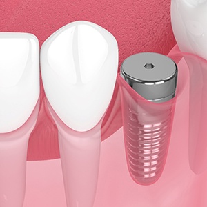 Digital illustration of dental implant in Cocoa Beach