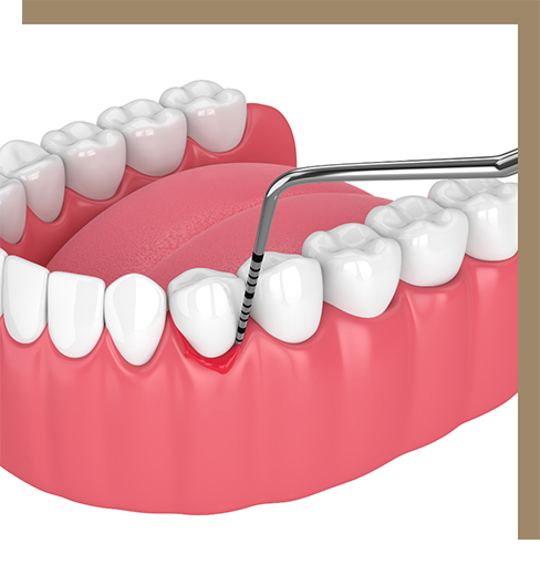 Illustration of biofilm being applied to an inflamed section of the gums