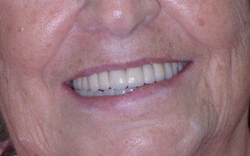Flalwess smile after fixed bridge and dental implant supported hybrid denture restoration