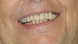 Worn and decayed smile before restorative dentistry