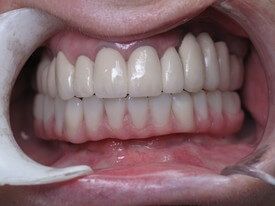 Closeup of healthy beautiful smile after restorative dentistry