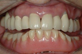 Closeup of worn and damaged smile before restorative dentistry