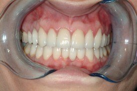 Closeup of healthy smile after gum tissue repair