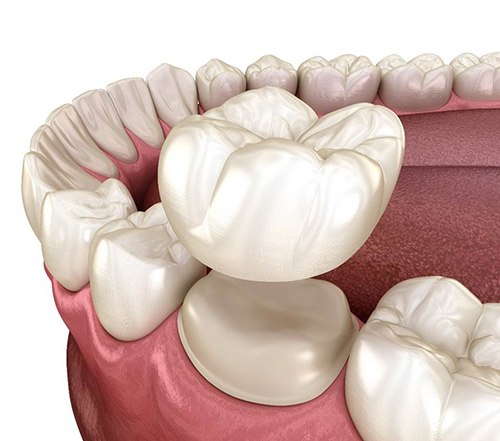 Illustration of a CEREC dental crown in Cocoa Beach, FL being placed on a tooth