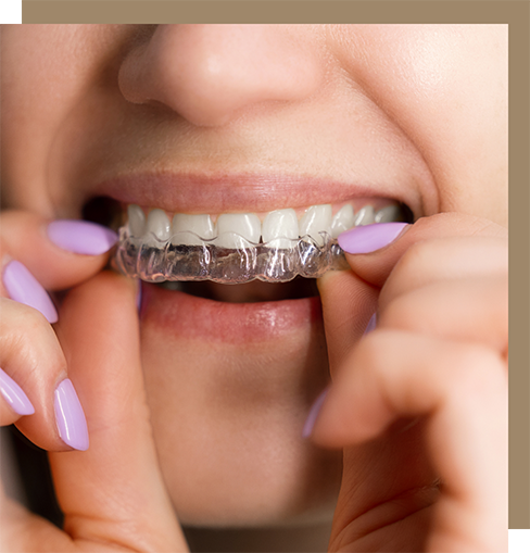 Placing a clear aligner over the teeth