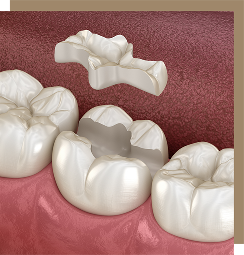 Dental inlay restoring a broken tooth