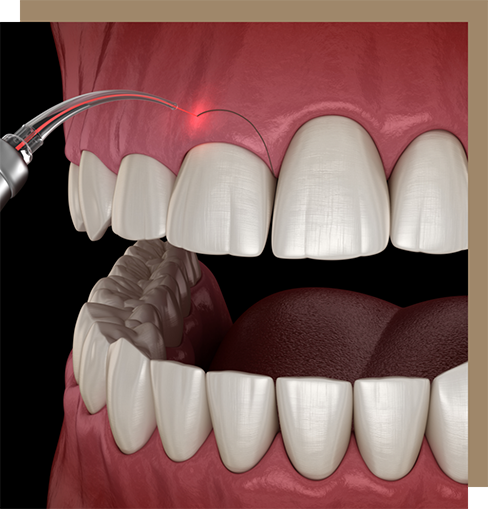 Dental laser correcting an uneven gumline