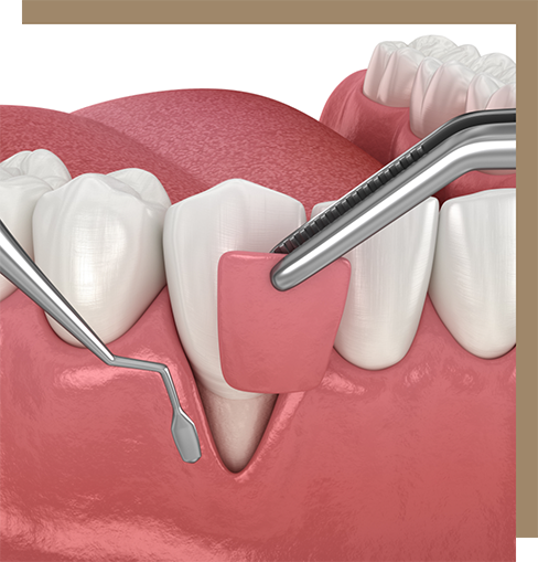 Illustration of a gum grafting procedure