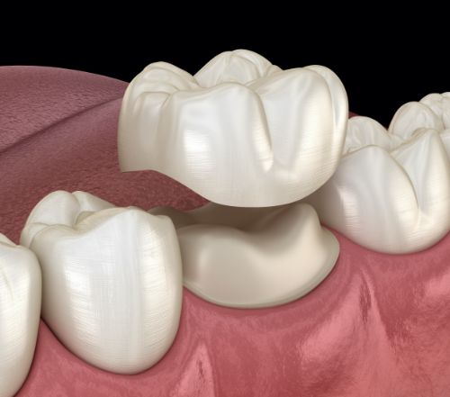 Animated smile during dental crown placement