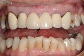 Decayed and damaged smile and failing dental restoration