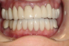 Healthy smile after dental crown restoration