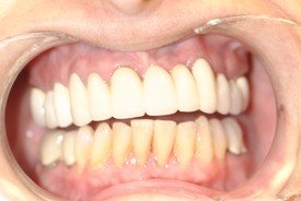 Discolored and decayed teeth before dental crown restoration