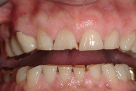Worn and damaged smile caused by bruxism before dental crown restoration