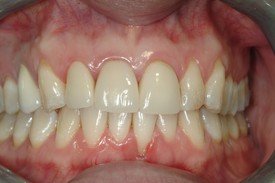 Discolored yellow smile before dental crown restoration