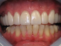 Healthy beautiful smile after dental crowns