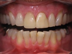 Discolored and damaged smile before dental crowns