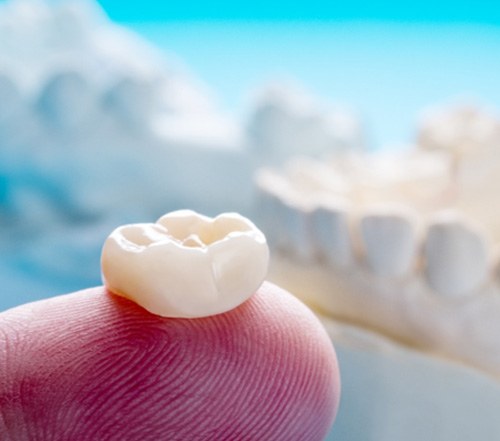 closeup of dental crowns in Cocoa Beach   
