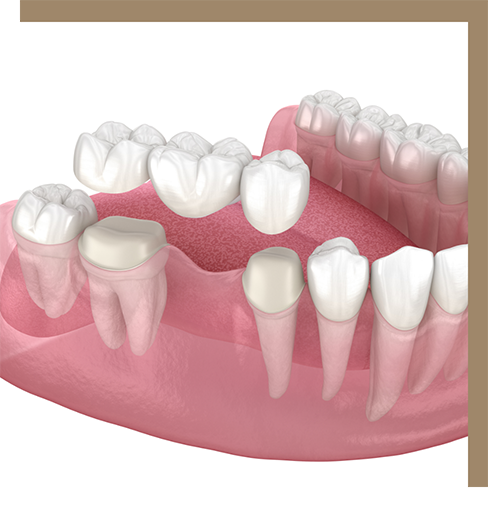 Illustration of a dental bridge replacing a missing tooth