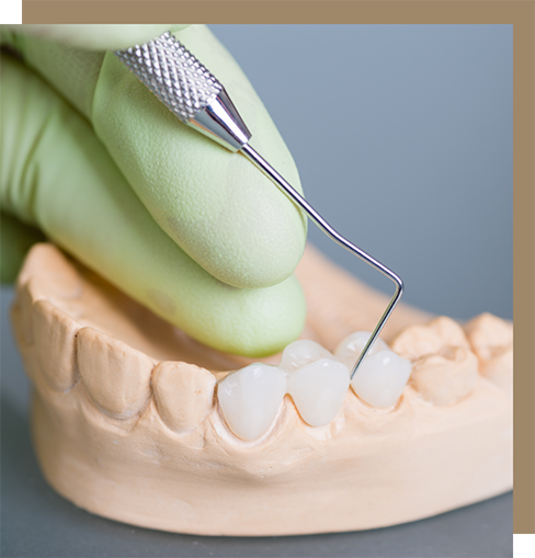 Dental bridge over three teeth in a model of the mouth