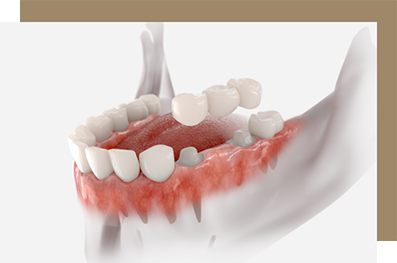 Model of a traditional dental bridge
