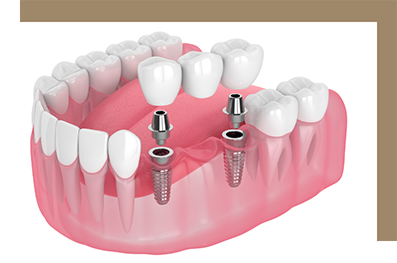 Model of an implant bridge