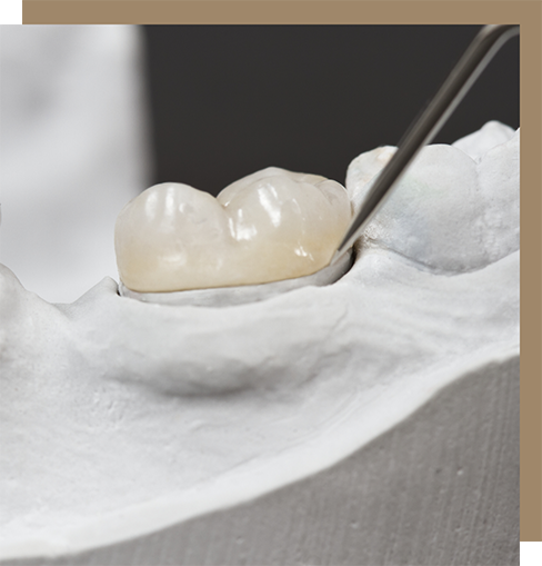 Dental crown covering a model of a tooth