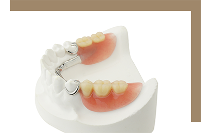 Partial denture in a model of the mouth