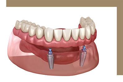 Illustration of an implant denture replacing all missing lower teeth