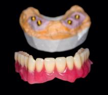 Model dental implant supported denture