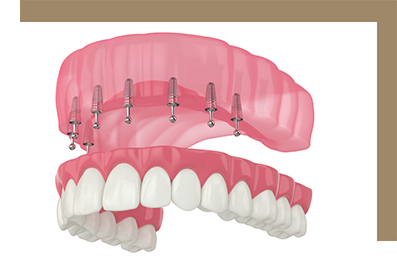 Model of an implant denture on the upper arch