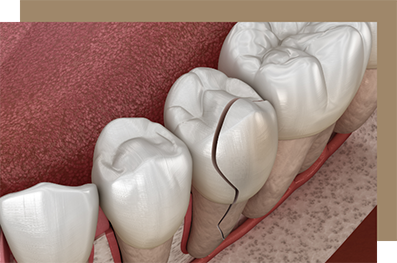 Illustration of a cracked tooth