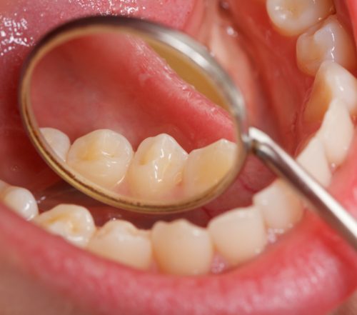 Closeup of healthy smile after tooth colored filling restoration