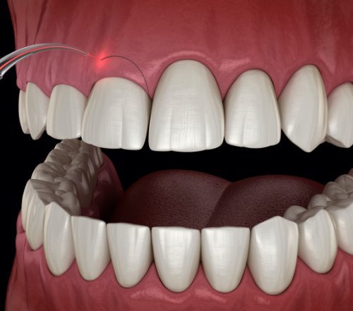 Animated smile during gum recontouring treatment