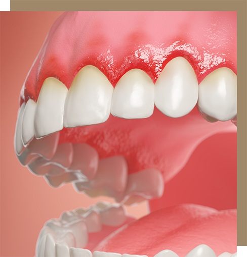 Illustrated mouth with inflamed gums