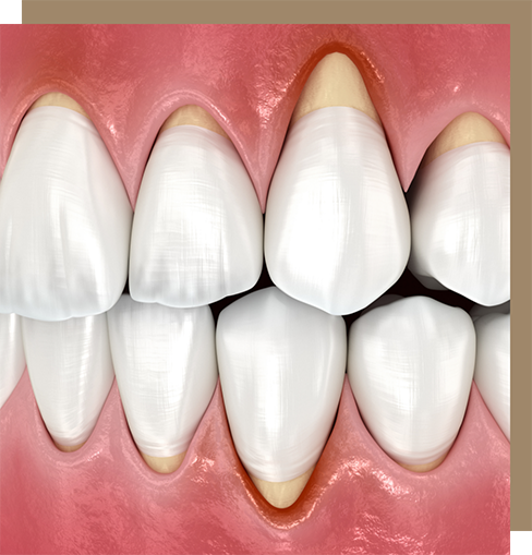 Illustrated mouth with receding gums