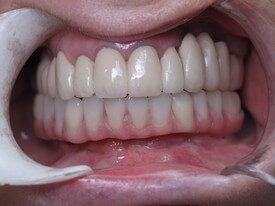 Flalwess smile after fixed bridge and dental implant supported hybrid denture restoration