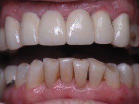 Decayed and damaged smile and failing dental restoration