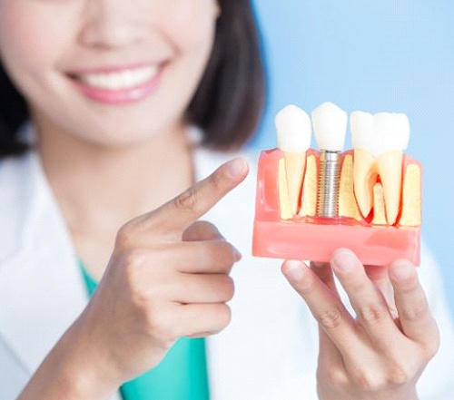 implant dentist in Cocoa Beach pointing to a model of a dental implant in the jaw