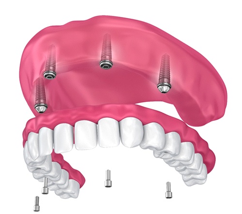 model of how implant dentures in Cocoa Beach work