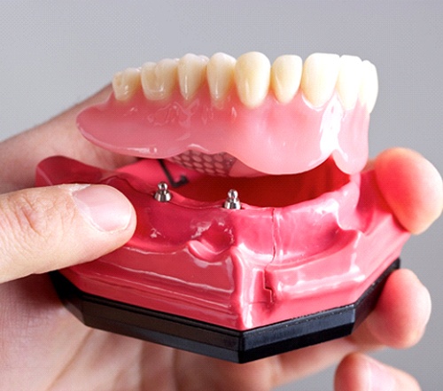 implant dentist in Cocoa Beach holding a model of the jaw with an implant denture