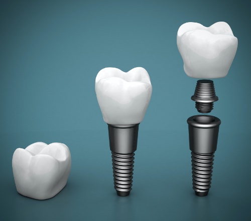 Components of dental implant supported dental crown