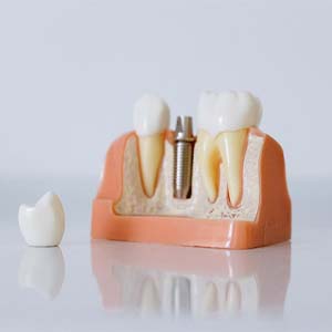 Model of a single dental implant