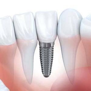 Animated dental implant supported dental crown placement