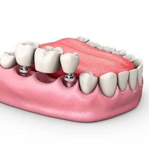 Animated dental implant supported fixed bridge placement