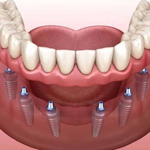 Animated dental implant supported denture placement