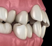 Animated smile with crowded teeth before Invisalign treatment