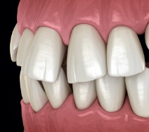 Animated smile with gaps between teeth before Invisalign treatment