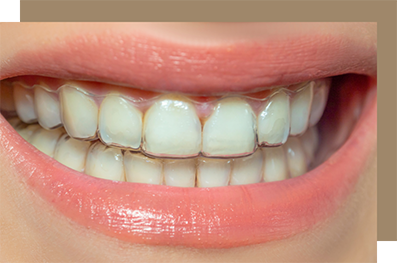 Close up of smile with clear aligners on teeth